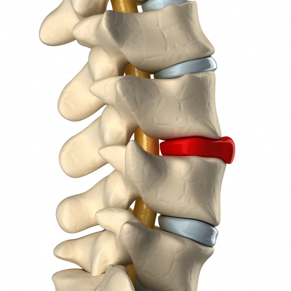 Is Disc Degeneration The Same As Herniated Disc